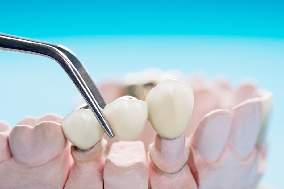 How Long Do Dental Bridges Last?